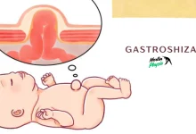 gastroshiza
