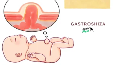 gastroshiza