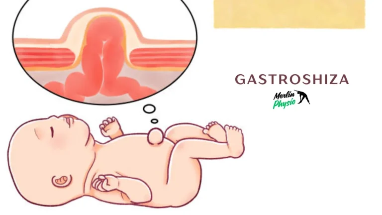 gastroshiza