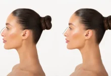 rhinoplasty in Toronto