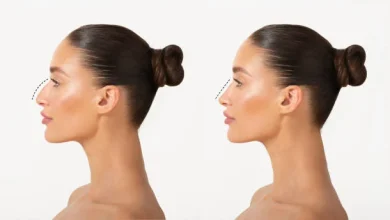 rhinoplasty in Toronto