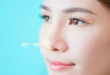 rhinoplasty treatment