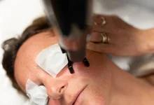 Laser Sun Spot Removal