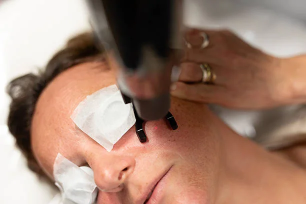 Laser Sun Spot Removal